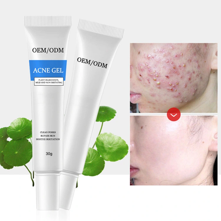 Custom Face Cream Oil Free Herba Anti Acne Gel Removal Acne Treatment Cream Skin Care